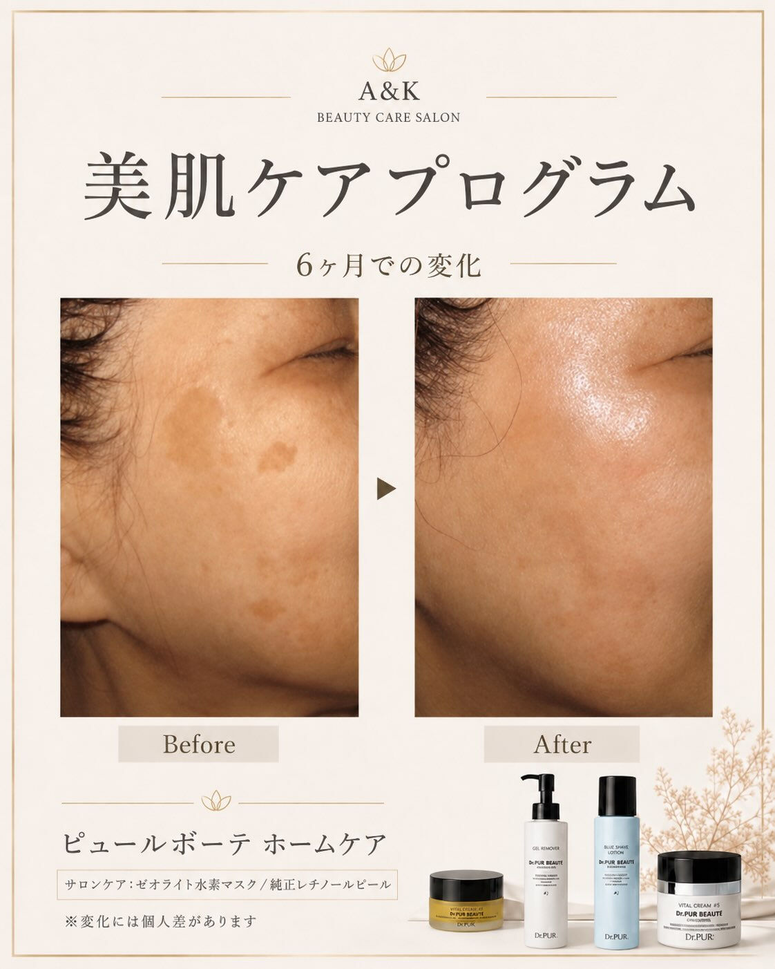 〜日やけによるシミや、そばかすが気になる方へ〜